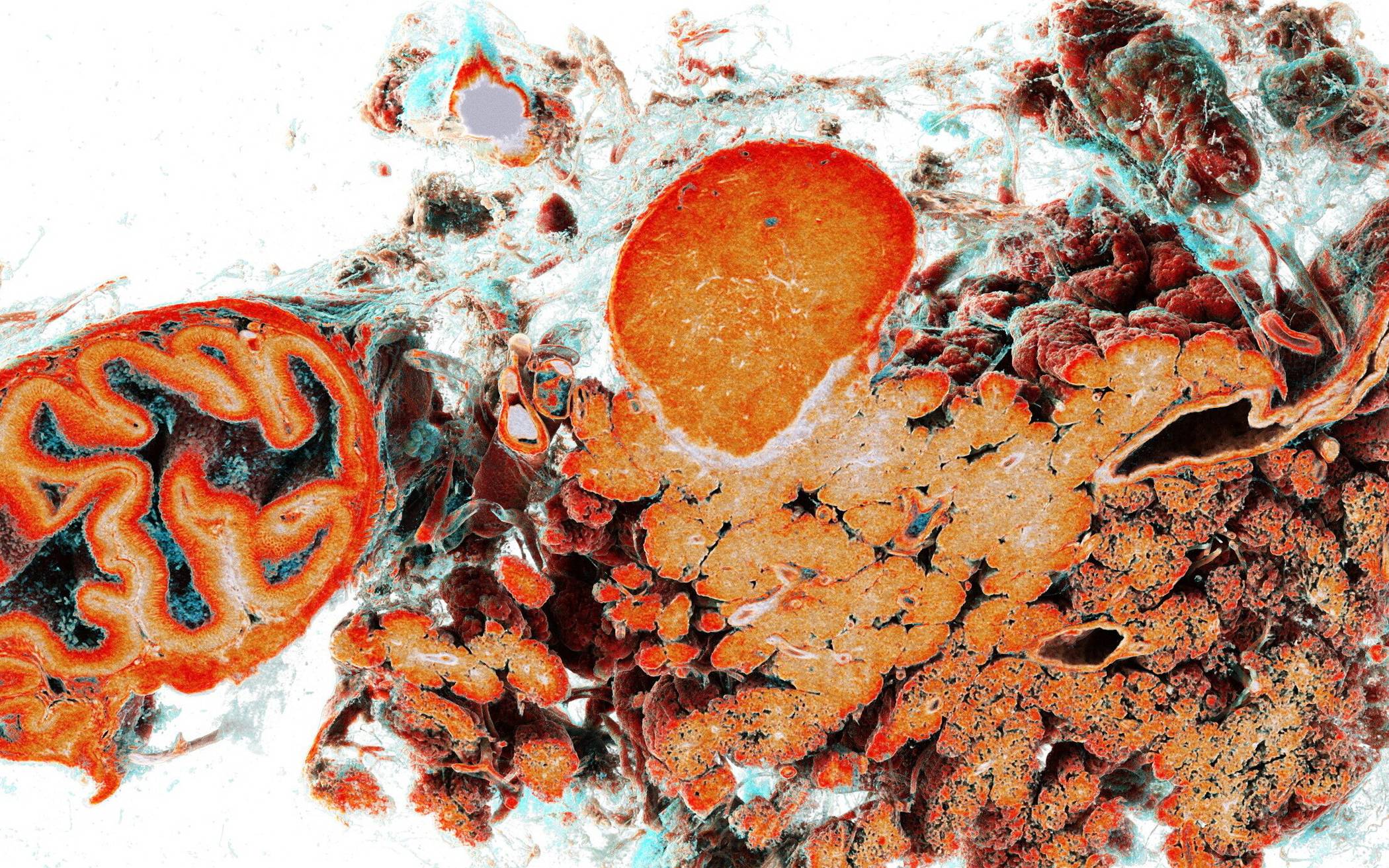 Synchrotron-basierten HiP-CT-Scans eines Whipple-Resektionspräparats (Zwölffingerdarm...