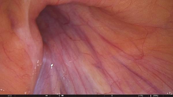 Das Bild zeigt den Leistenbruch, also das Loch in der...