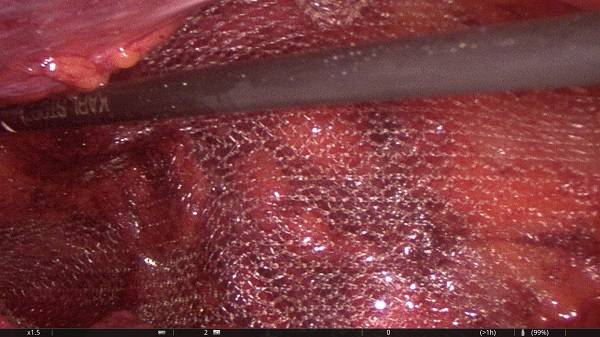 Das Bild zeigt das Verschließen mittels einer Netzeinlage....