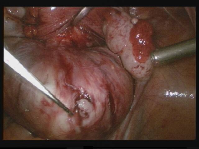 Ein Myom ist ein gutartiger Muskelknoten. Nicht immer wird ein minimal-invasiver...