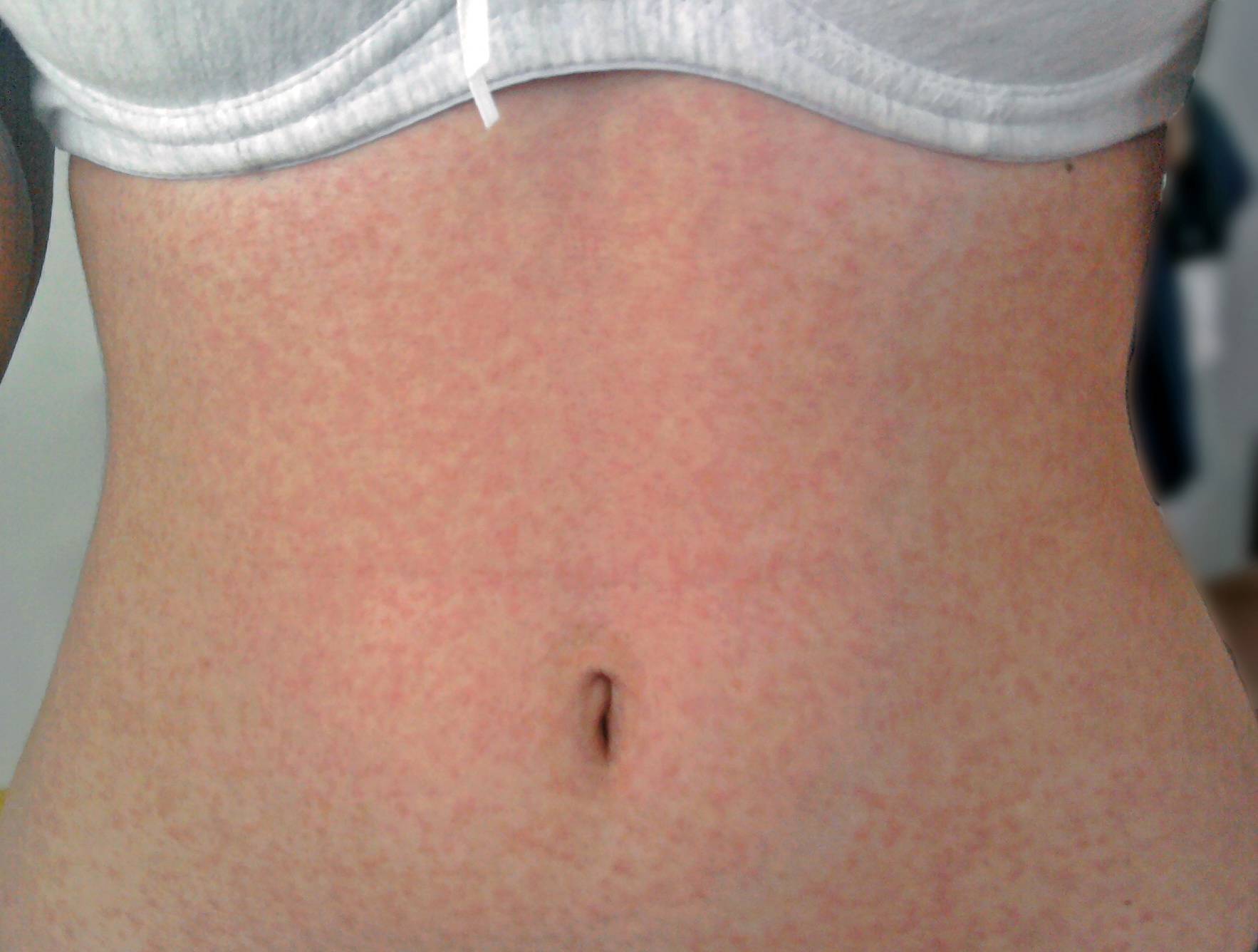  Typische Hauterscheinungen bei Masern. 